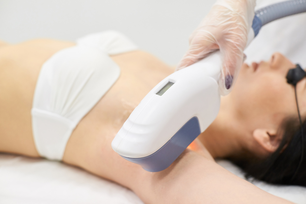 Woman Undergoing a Laser Hair Removal Treatment